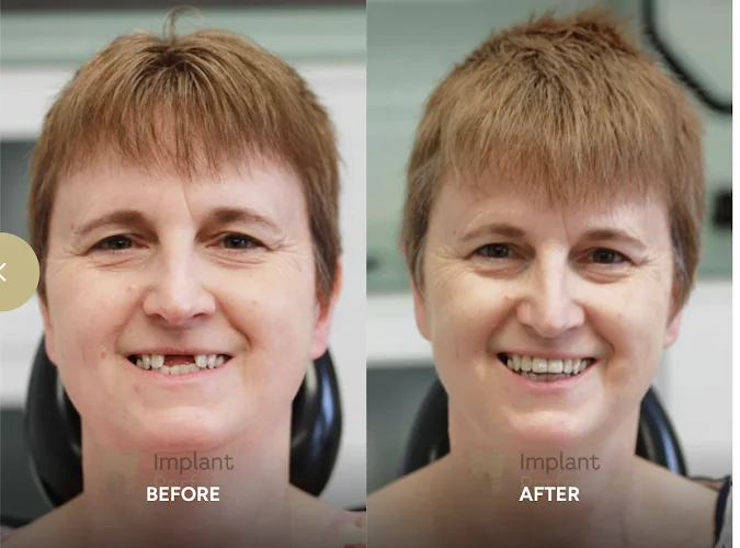 Implant Perfection - Dental Implants Derby - Dental implants provider in Derby