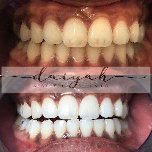 D A I Y A H Aesthetic Clinic - Teeth whitening service in London