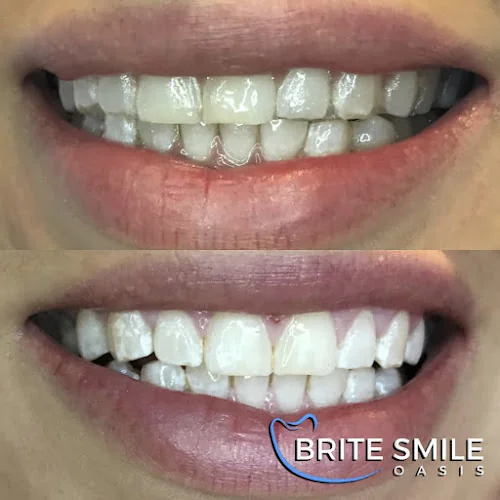 Brite Smile Oasis - Teeth whitening service in Barnsley