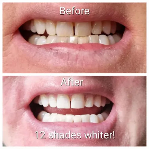 MRS WHITE SMILE - LASER TEETH WHITENING - Teeth whitening service in Torquay