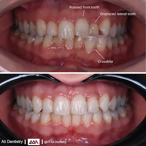 Teeth Straightening Swindon - Cosmetic dentist in Swindon