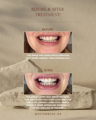 Splendida - Teeth whitening service in London