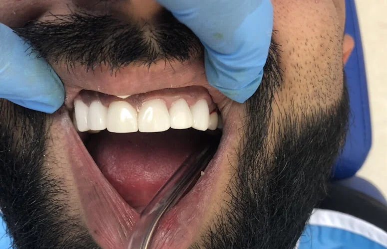 London Veneers - Dentist in London