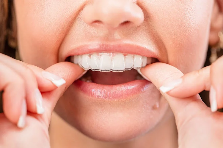 Impress - Orthodontist in Liverpool