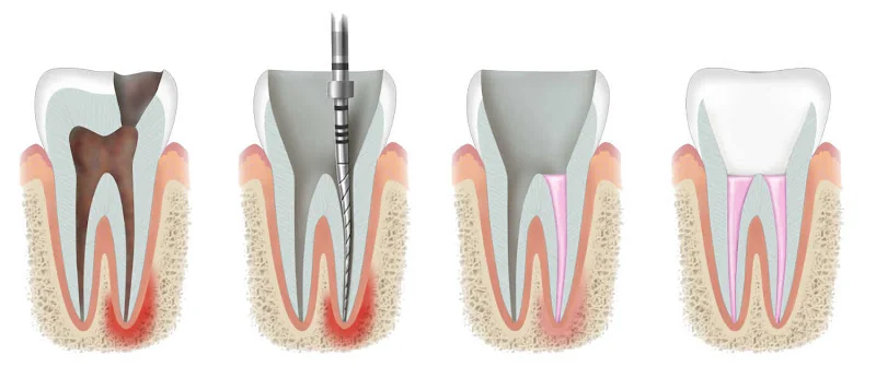 Root canal Leicester - Endodontist Leicester - Dentist in Leicester