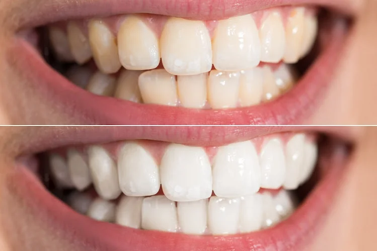 London Teeth Whitening - Dental clinic in London