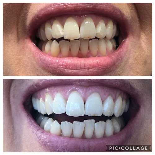 Teeth Whitening Northwales - Teeth whitening service in UK