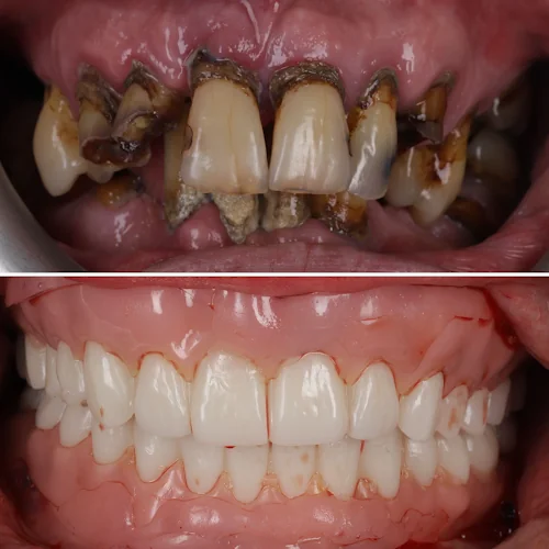 Digital dentures Glasgow, scan and fit - Denture Care Centre in Glasgow