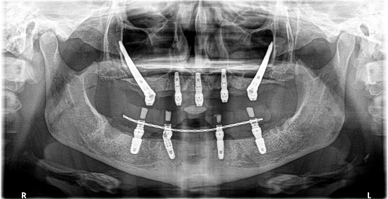 Dental Implant Training UK - Dental implants provider in St Albans