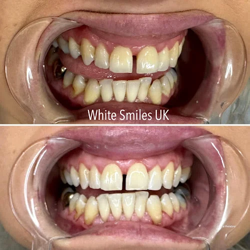 White Smiles UK - Teeth whitening service in Swindon