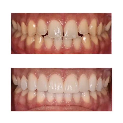 Watford Smiles Invisalign - Dentist in Watford
