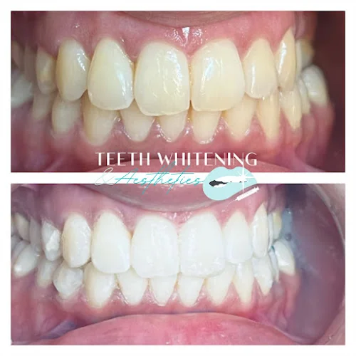 Teeth whitening and Aesthetics - Teeth whitening service in Bristol
