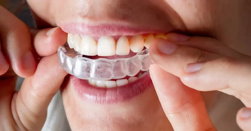 Invisalign Dentist Leicester - Dentist in Leicester