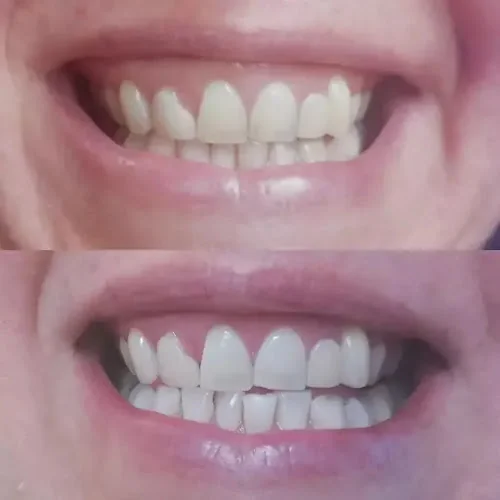 ELW.COSMETICS - Teeth whitening service in Bolton
